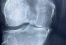 Knee X Rays Arthritis Skeleton  - Taokinesis / Pixabay