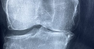 Knee X Rays Arthritis Skeleton  - Taokinesis / Pixabay